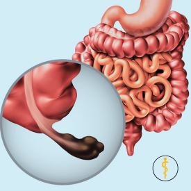 Laparoscopic Appendicectomy