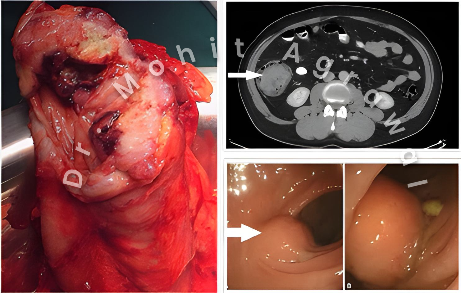 Carcinoid tumors specialist