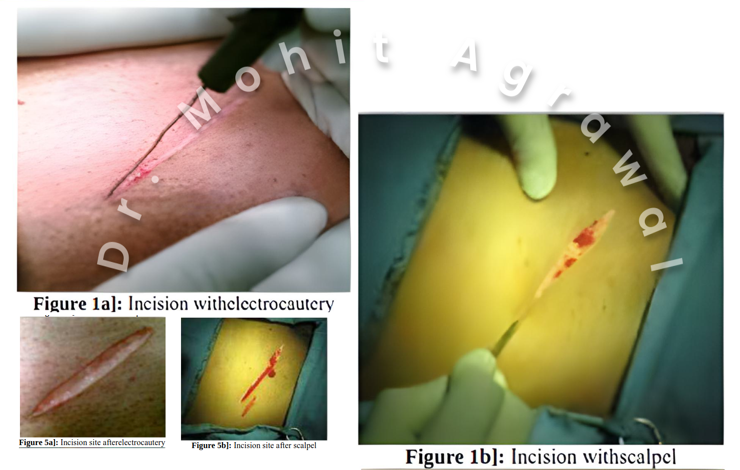 Diathermy versus Scalpe