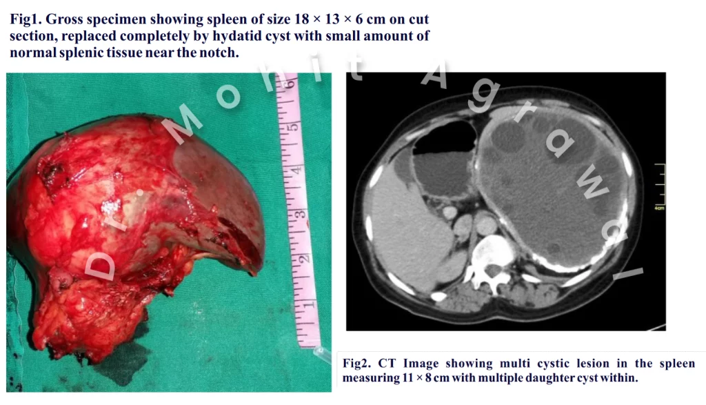 Giant Solitary Splenic Hydatid Cyst