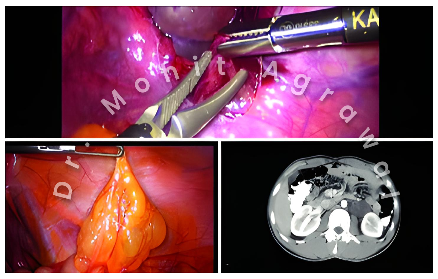 Laparoscopic-excision