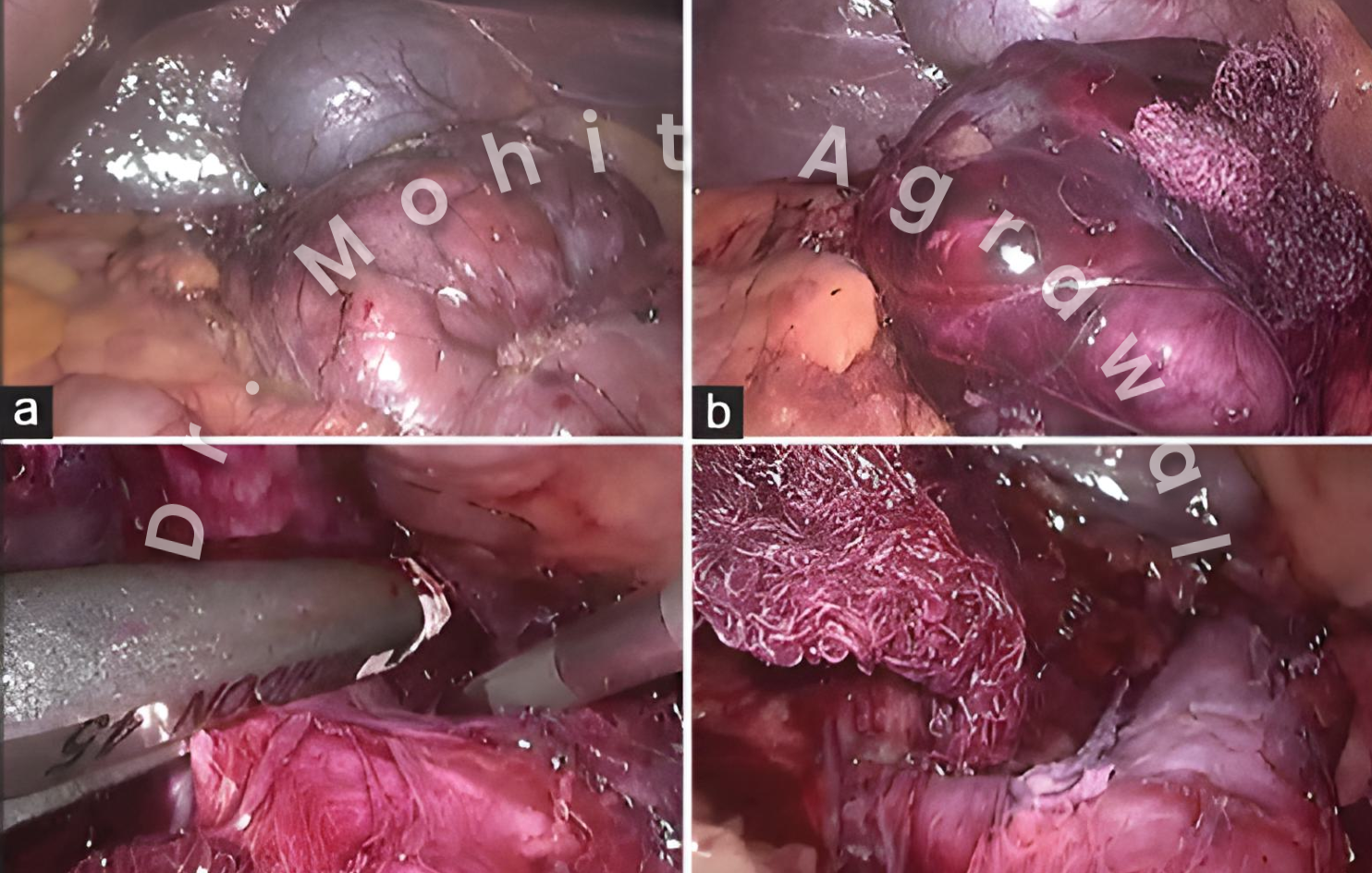 Laparoscopic tomour removal