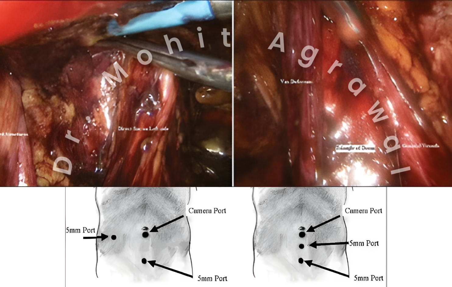 Herniaplasty