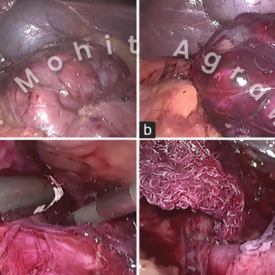 Robotic Laparoscopic Surgery