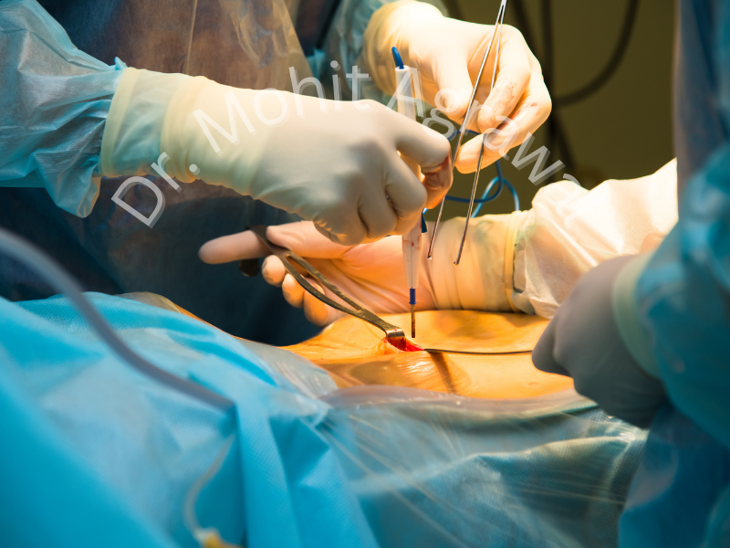 Single incision laparoscopic surgery